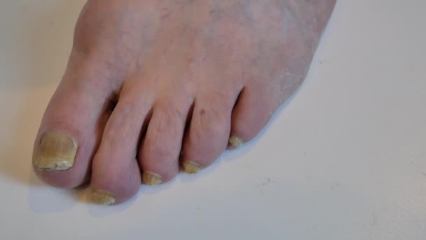 Pied Vieil Homme Avec Des Maladies Comme Champignon Des Ongles — Video