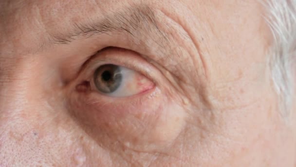 Primer Plano Del Anciano Con Inflamación Los Ojos Rojos Causada — Vídeos de Stock