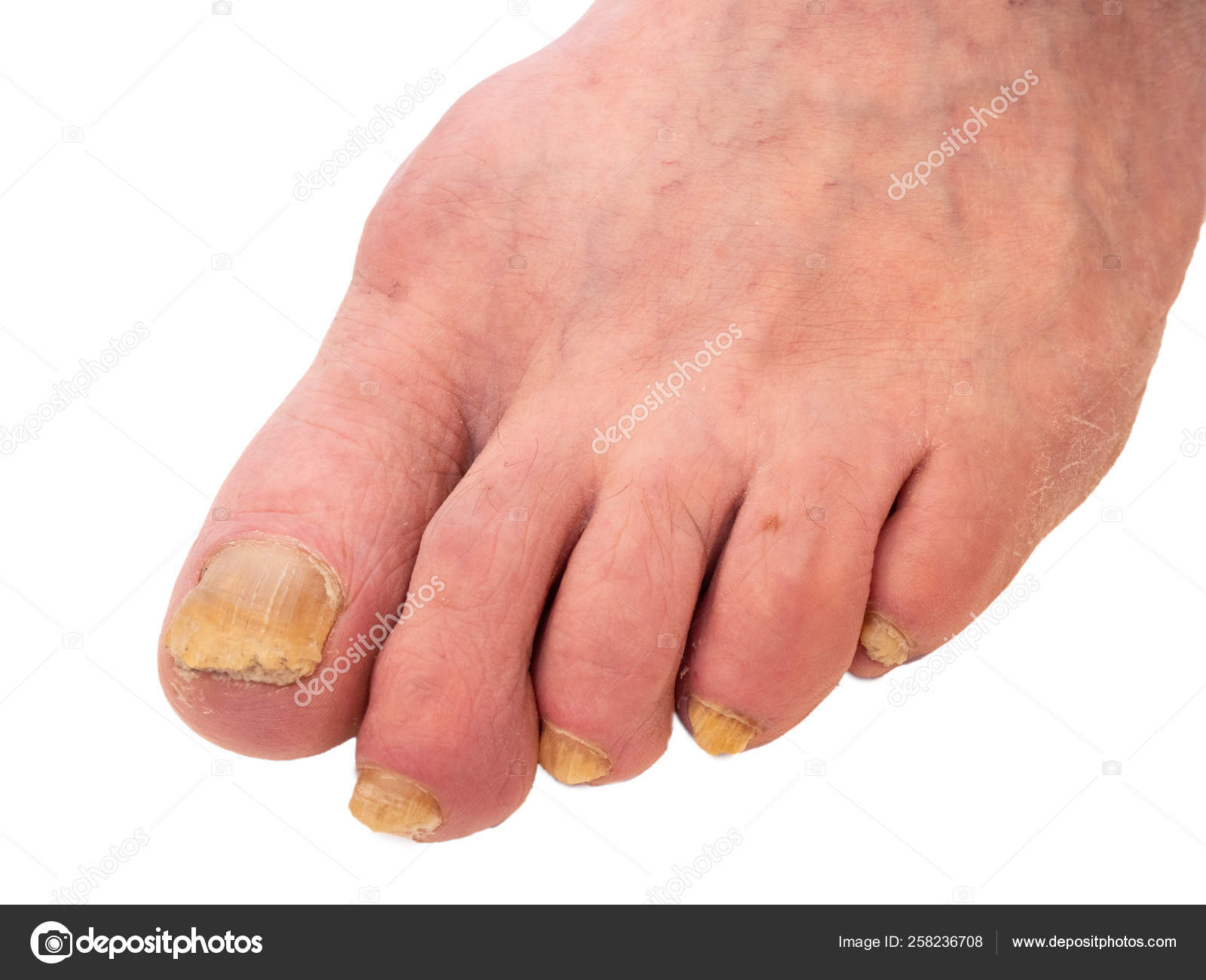 gomba nail foot salt)