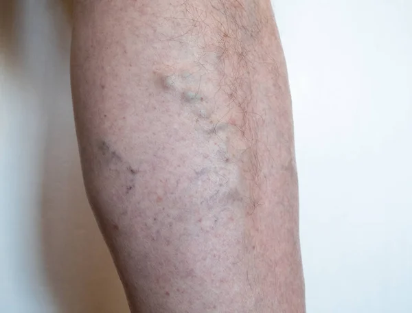 Varisli yaşlı adamın bacağı - genişlemiş, şişmiş ve büküm damarları zaman yanlış yönde kan akışı — Stok fotoğraf