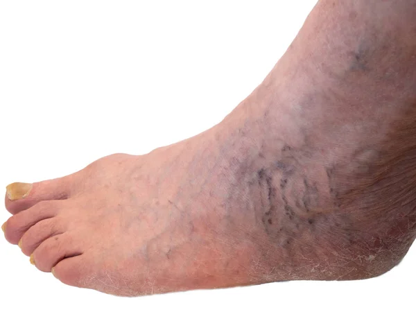 Старший старий нога з такими захворюваннями, як грибок на нігтях і капілярна сітка варикоз, ізольовані вирізані на білому тлі — стокове фото