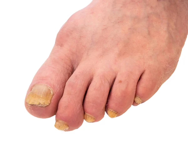 Nahaufnahme des menschlichen Fußes mit Nagelpilz. Oberfläche ist krank und hat eine unnatürliche gelbe Farbe. Bild isolierter Ausschnitt auf weißem Hintergrund — Stockfoto