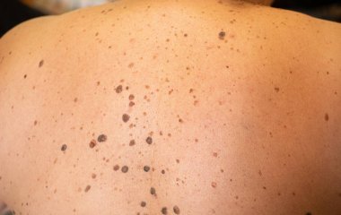 vücut sırt kahverengi nevus üzerinde çok ile klinik çalışmalarda kadın hasta