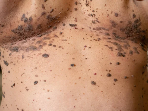 Close-up many large big brown nevus on human chest skin body — Stock Photo, Image