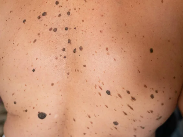 kahverengi nevüs çok insan düşük ve orta sırt.