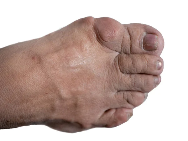 Pie humano con juanete hueso grande cerca de hallux dedo gordo sobre fondo blanco. imagen aislada recorte — Foto de Stock