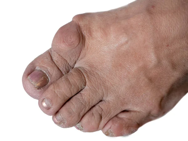 Primer plano de pies de mujer con juanete en hallux — Foto de Stock