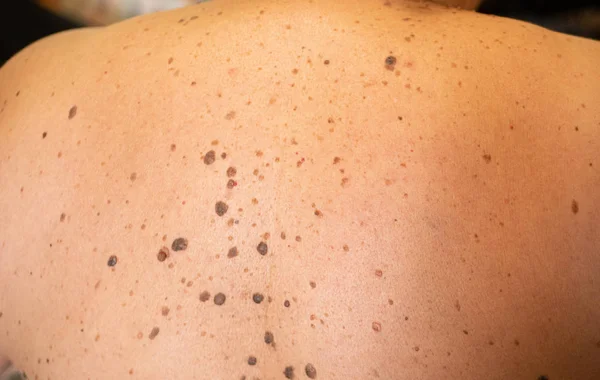Woman patient on clinical trials with lot on brown nevus on body back Stock Photo