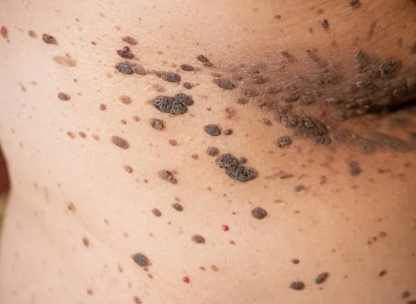 Closeup of large brown nevus moles on human body skin Stok Gambar