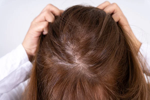 女性の頭の脱毛を閉じます 頭の上で髪を薄く 医療や生活の概念 — ストック写真