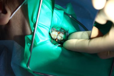 Açık bir bebek dişi. Çoklu derin kalp yetmezliği operasyonu. Sağlık kavramı. Boşluğu kopyala.