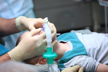 Ameliyattan önce çocuğun genel anesteziye girmesi. Ciğerlerin yapay havalandırma cihazı. Uzayı kopyala. Tanımlanamayan fotoğraf.