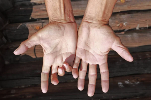 Close Duas Mãos Feridas Com Cortes Antigos Novos Fundo Parede — Fotografia de Stock