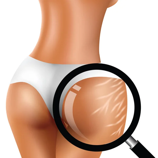Stretch Marks Woman Buttocks Magnifying Glass — Stock Vector
