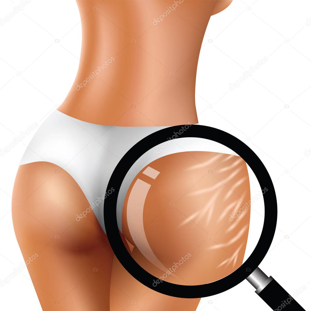 Stretch marks on woman's buttocks and Magnifying glass