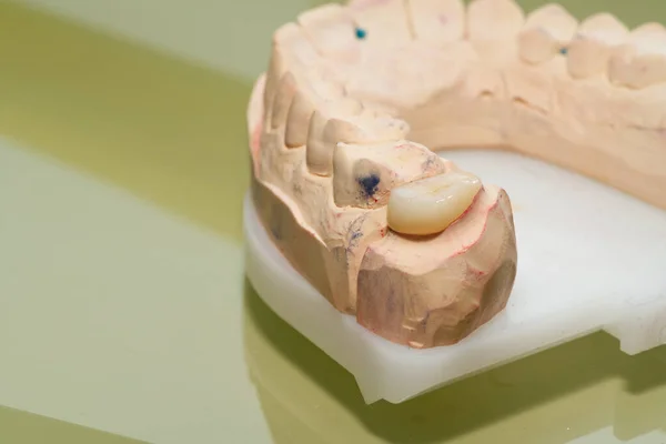 Tüm seramik kaplamalı, seramik kaplamalı ve zirkon kaplamalı diş modeli.