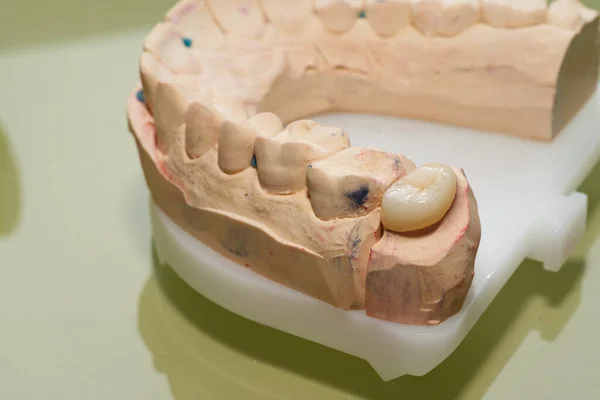 dental model with all ceramic veneer, ceramic crown and zirconia crown, side view