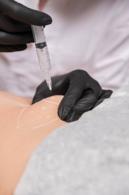 Kozmetik doktoru kliniğinde bir kadına lipolitik enjeksiyon yapıyor. Siyah parıltı ve maske takıyor ve şırıngayı iğneyle tutuyor..