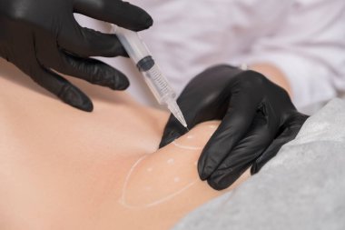 Kozmetik doktoru kliniğinde bir kadına lipolitik enjeksiyon yapıyor. Siyah parıltı ve maske takıyor ve şırıngayı iğneyle tutuyor..