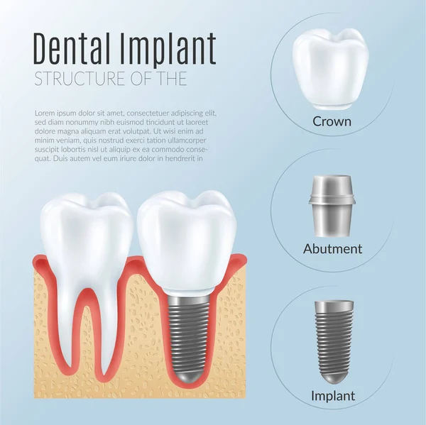 Realistische Implantat-Infografik — Stockvektor