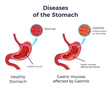 Gastrit mide Set