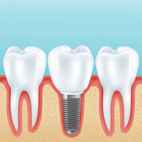 Implantes dentários ilustração realista — Vetor de Stock