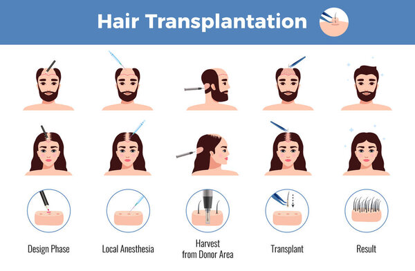 Hair Transplantation Men Women Infographics