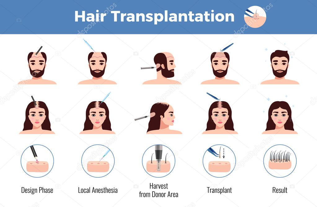 Hair Transplantation Men Women Infographics