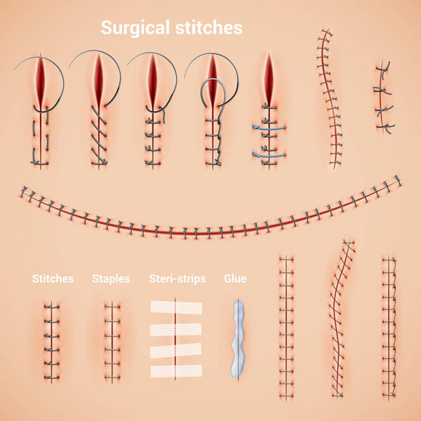 Surgical Stitches Infographic Set