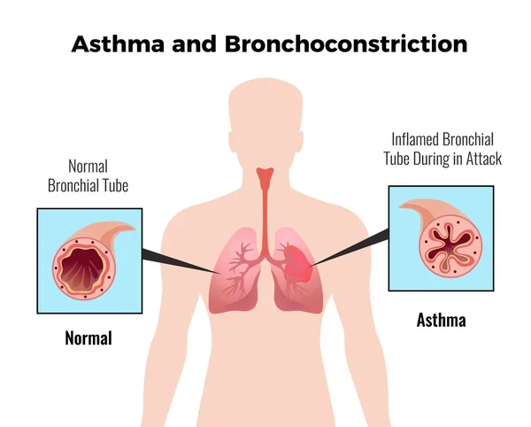 Cartel médico del asma — Vector de stock