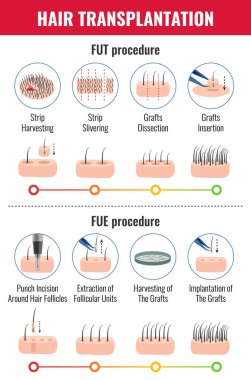 Saç ekimi Infographics