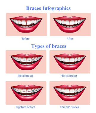Diş diş telleri türleri gerçekçi Infographics 