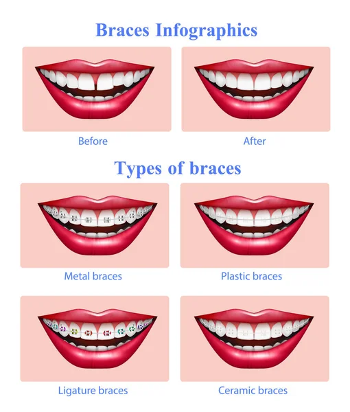 Tipos de aparatos dentales Infografías realistas — Archivo Imágenes Vectoriales