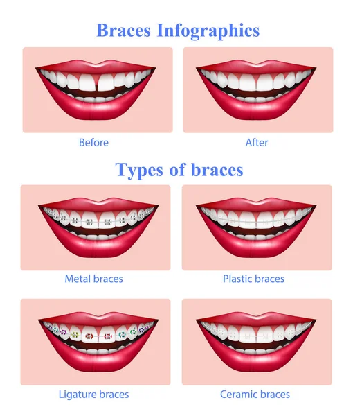 Dentes Braces Tipos Infográficos Realistas — Vetor de Stock