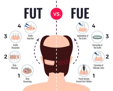 Saç Nakli Fut Fue 'ye Karşı 
