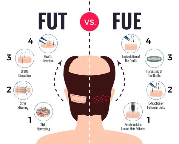 Trasplante capilar Fut Vs Fue — Archivo Imágenes Vectoriales