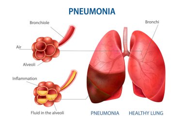 Pneumonia Realistic Set clipart
