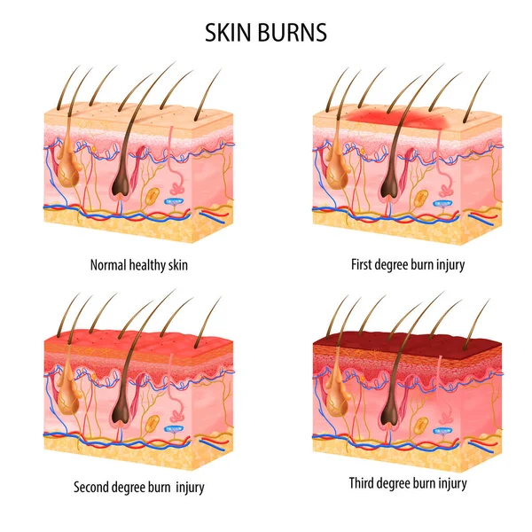 現実的な皮膚火傷分類 — ストックベクタ