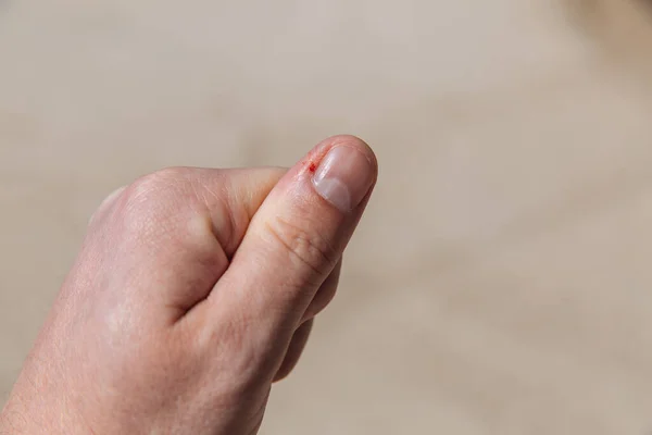 Thumb trauma. Bleeding from a cut finger. Blood from a finger.