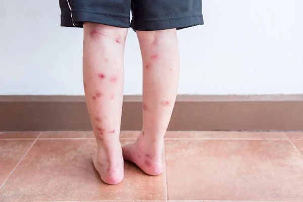 Kinderbeine Mit Vielen Roten Flecken Und Narben Nach Insektenstichen — Stockfoto