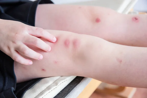 虫刺されから赤い斑点が多く 子供の足 — ストック写真