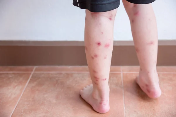 Patas Niño Con Muchas Manchas Rojas Cicatrices Por Picadura Insecto —  Fotos de Stock