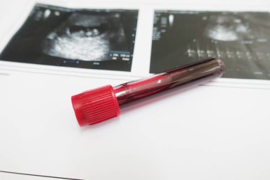 Laboratuvarda kromozom testi için kan. 