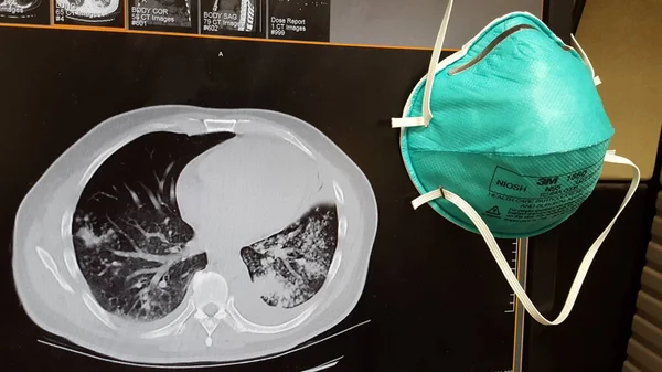 N-95 Ademhalingsisolatiemasker met CT-scan van de borst toont TB pneumonie — Stockfoto