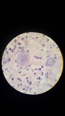 Cilt biyopsisi örneğinde Coccidioides imitis küreleri