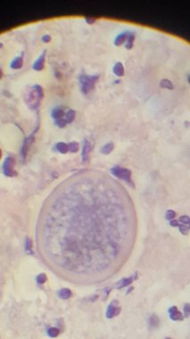Coccidioides imitis spherule in skin biopsy specimen clipart