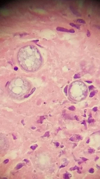 Coccidioides imitis esférulas en muestra de biopsia de piel — Foto de Stock