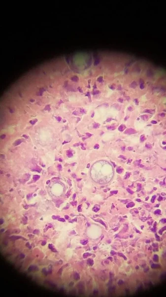 Κοκκιδιοειδή σφαιρίδια ιμίτιδας σε δείγμα βιοψίας δέρματος — Φωτογραφία Αρχείου
