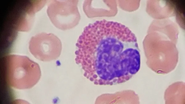 Eosinofilo e globuli rossi sullo striscio di sangue periferico — Foto Stock