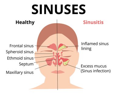 Sinüzit tedavisi. Burun sinüsü. Sağlıklı ve iltihaplı sinüs. Burun hastalıkları. Sinüzit, sinüs enfeksiyonu teşhisi tıbbi bilgi tasarımı. Otolaryngology konsepti. Beyazda izole edilmiş